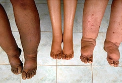 A Visual Guide to Lymphedema